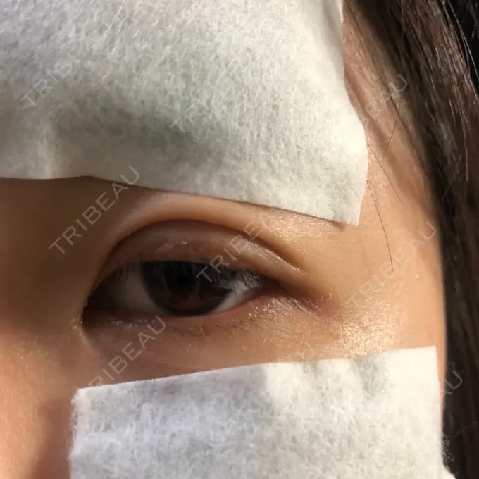 二重埋没 湘南美容クリニック 京都院 DAY 0 メイン用