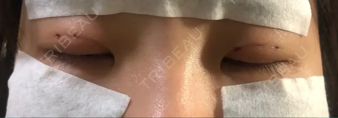 二重埋没 湘南美容クリニック 京都院 DAY 0 メイン用