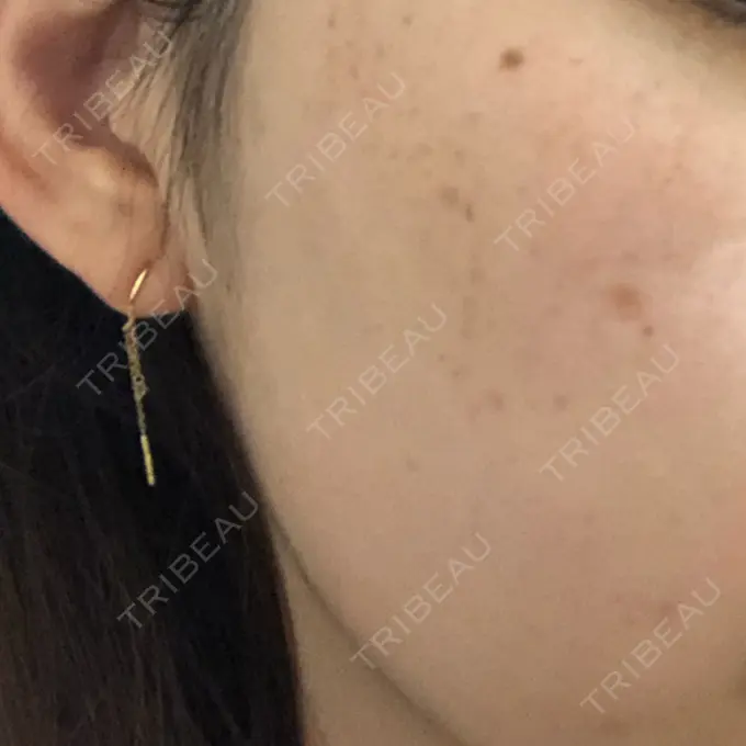 シミ取りレーザー 野口皮膚科医院 DAY 21 メイン用