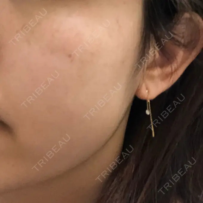 シミ取りレーザー 野口皮膚科医院 DAY 21 メイン用