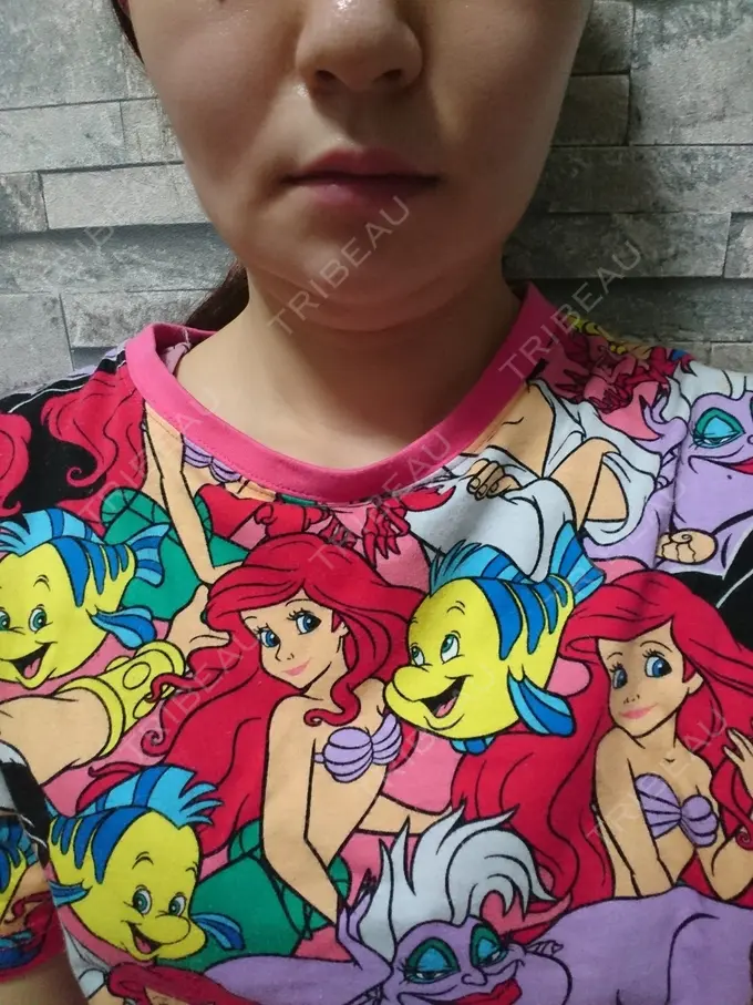 脂肪溶解注射（顔） ヴェリテクリニック 銀座院 DAY 8 メイン用