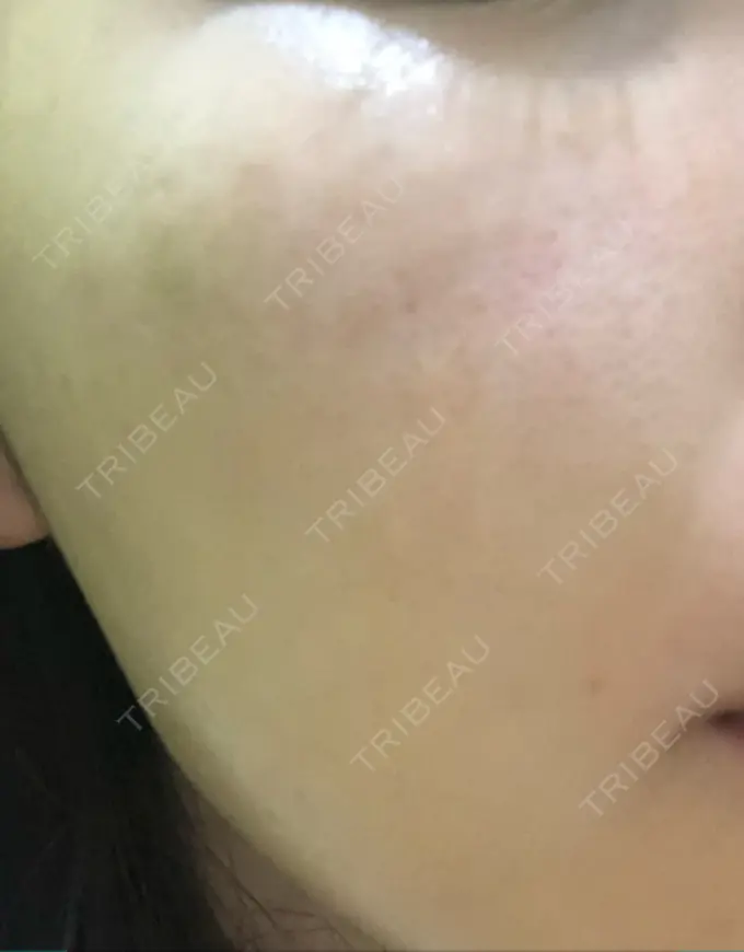 水光注射（ハリ・美肌） プチパーティー医院 DAY 3 メイン用