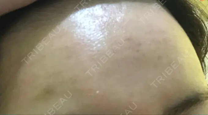 水光注射（ハリ・美肌） プチパーティー医院 DAY 3 メイン用