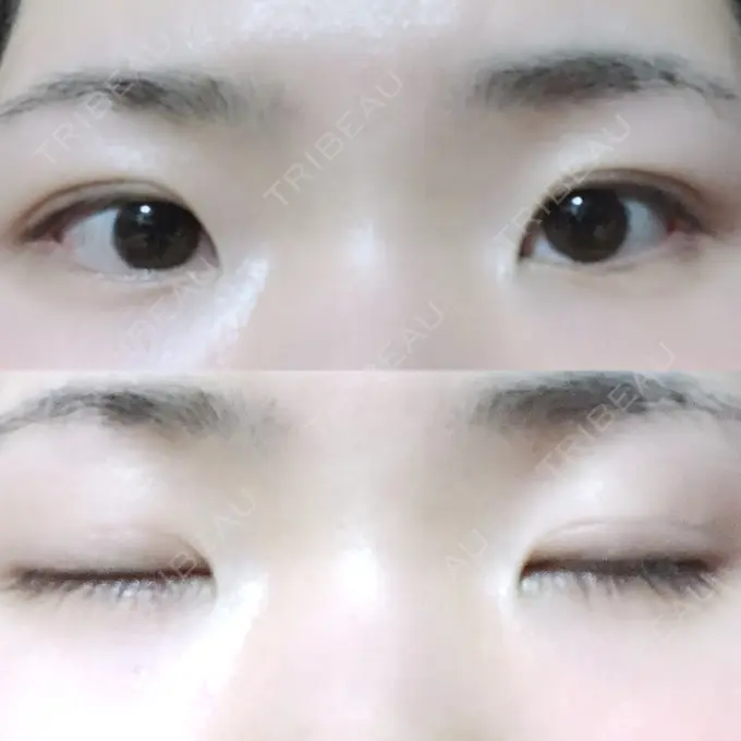 二重埋没 / 上まぶたの脂肪取り 東京ヒルズクリニック 岡崎院 DAY 63 メイン用