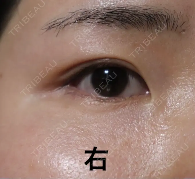 二重埋没 / 上まぶたの脂肪取り 東京ヒルズクリニック 岡崎院 DAY 63 メイン用