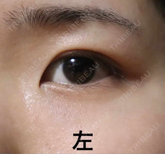 二重埋没 / 上まぶたの脂肪取り 東京ヒルズクリニック 岡崎院 DAY 63 メイン用