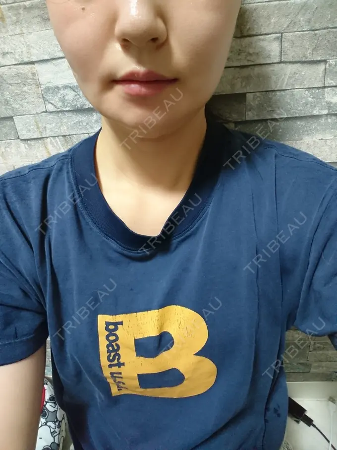 脂肪溶解注射（顔） ヴェリテクリニック 銀座院 DAY 9 メイン用