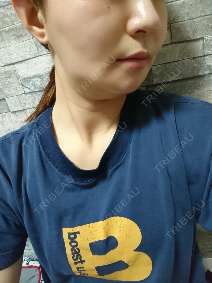 脂肪溶解注射（顔） ヴェリテクリニック 銀座院 DAY 9 メイン用