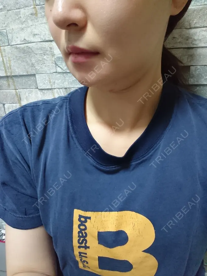 脂肪溶解注射（顔） ヴェリテクリニック 銀座院 DAY 9 メイン用