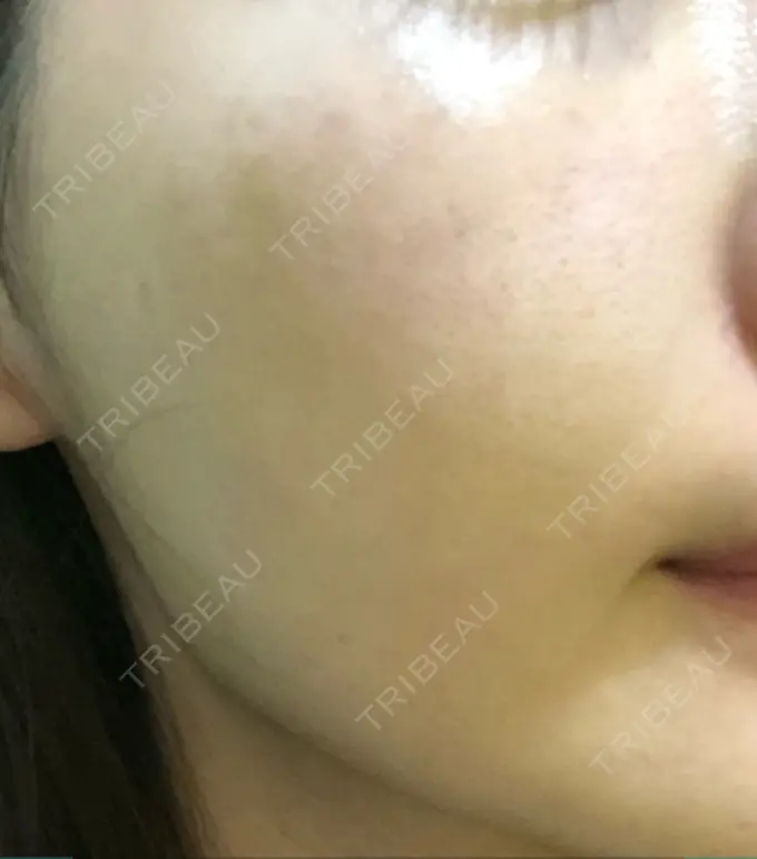 水光注射（ハリ・美肌） プチパーティー医院 DAY 4 メイン用