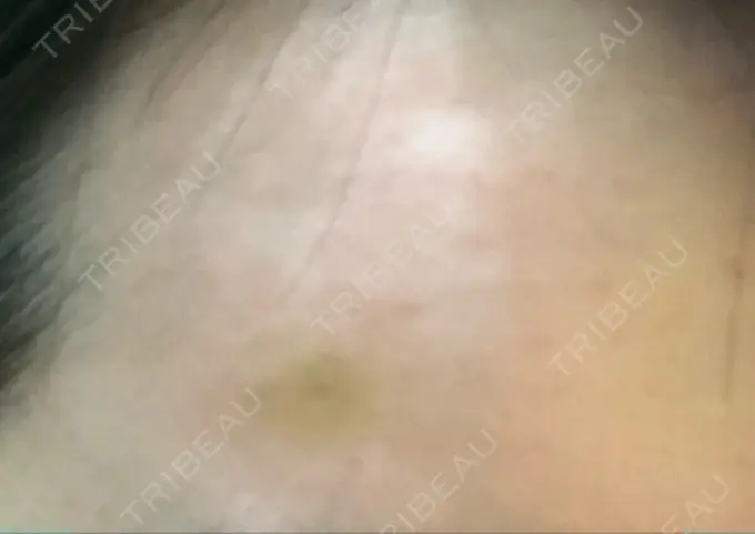 水光注射（ハリ・美肌） プチパーティー医院 DAY 4 メイン用