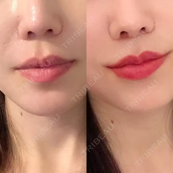 人中短縮 / 口唇縮小術 / 口角挙上 HB整形外科 DAY 120 メイン用