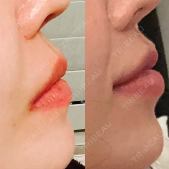 人中短縮 / 口唇縮小術 / 口角挙上 HB整形外科 DAY 120 メイン用
