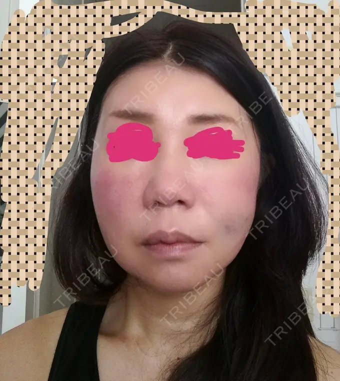 糸リフト 有楽町高野美容クリニック DAY 33 メイン用