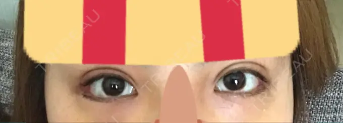 目尻切開 / 自然癒着法 FROM B整形外科 (旧バウム整形外科) DAY 15 メイン用