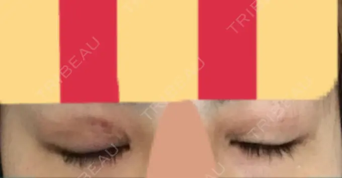 目尻切開 / 自然癒着法 FROM B整形外科 (旧バウム整形外科) DAY 15 メイン用