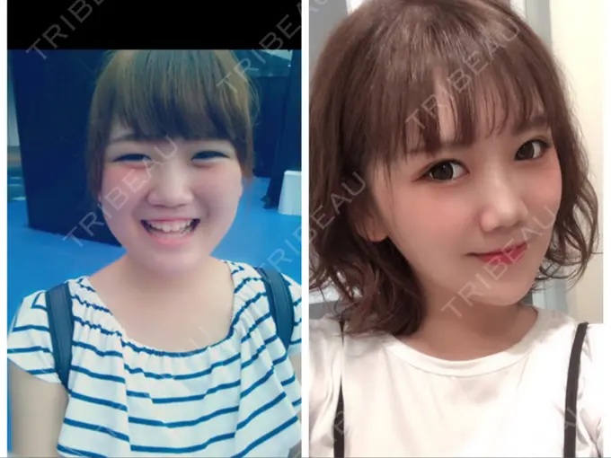 骨切り（あご） / 脂肪吸引（顔） 東京美容外科 赤坂院 AFTER メイン用