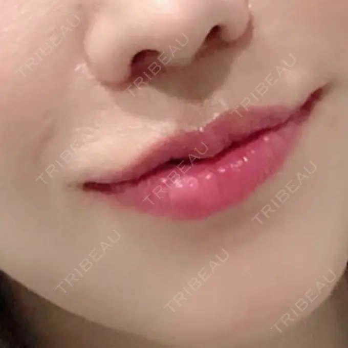人中短縮 / 口唇縮小術 / 口角挙上 HB整形外科 DAY 120 メイン用