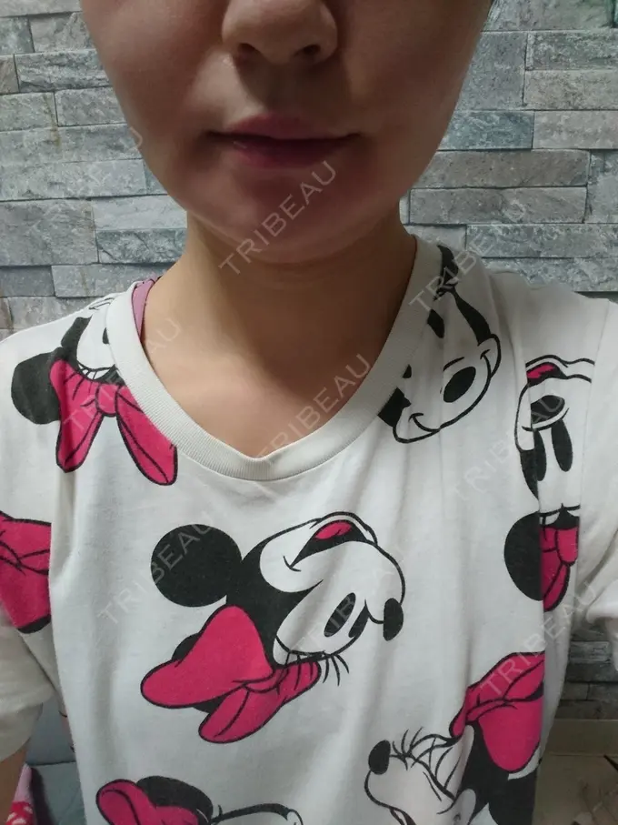 脂肪溶解注射（顔） ヴェリテクリニック 銀座院 DAY 10 メイン用