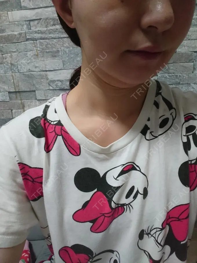 脂肪溶解注射（顔） ヴェリテクリニック 銀座院 DAY 10 メイン用