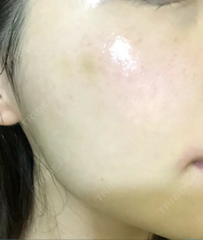 水光注射（ハリ・美肌） プチパーティー医院 DAY 6 メイン用