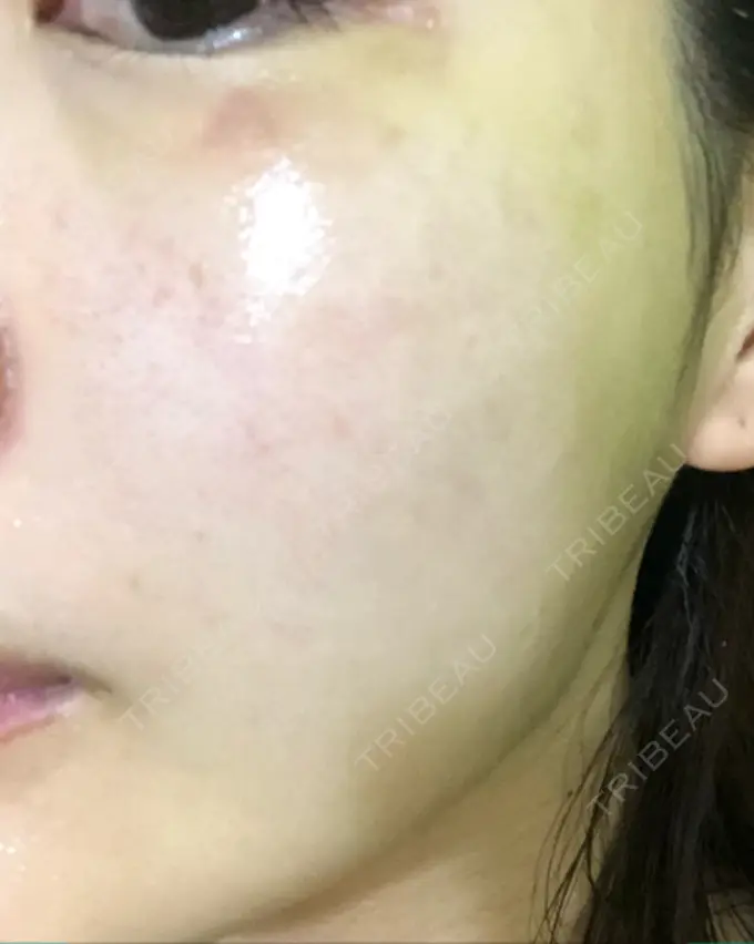 水光注射（ハリ・美肌） プチパーティー医院 DAY 6 メイン用