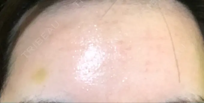 水光注射（ハリ・美肌） プチパーティー医院 DAY 6 メイン用