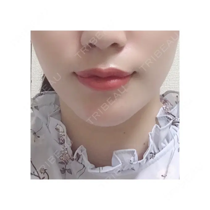 バッカルファット除去 / 脂肪吸引（顔） / ヒアルロン酸注入（鼻） / ボトックス（あご） / 水光注射（ハリ・美肌） / ヒアルロン酸注入（あご） / ボトックス（エラ・小顔） / 白玉点滴・注射 エートップ美容整形外科 AFTER メイン用