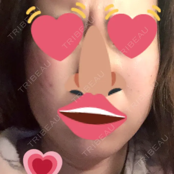 脂肪吸引（顔） フレッシュ整形外科 DAY 25 メイン用