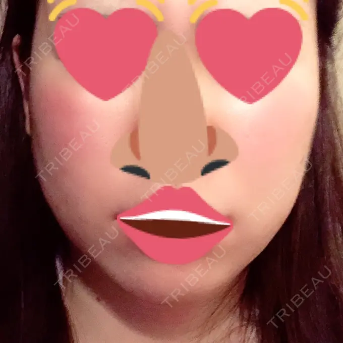 脂肪吸引（顔） フレッシュ整形外科 DAY 29 メイン用