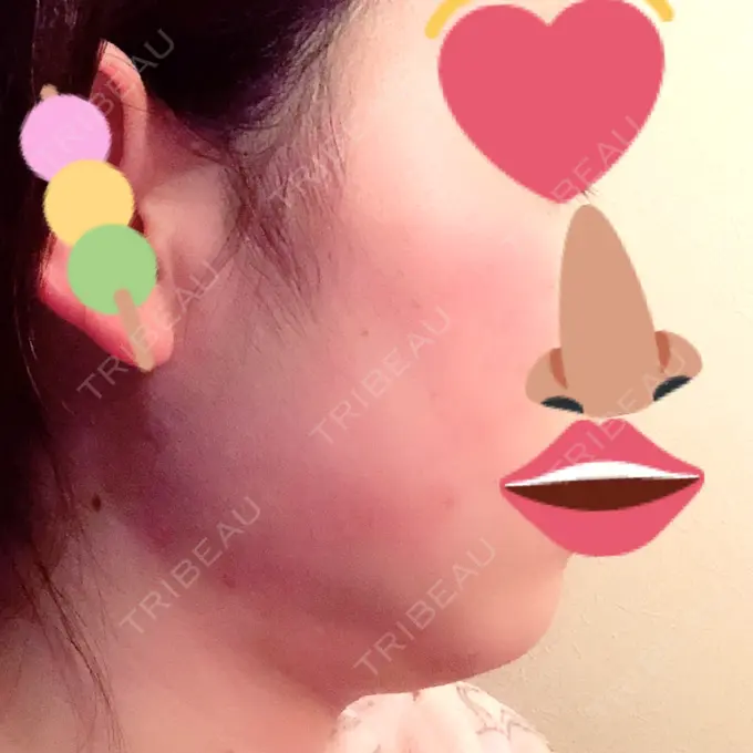 脂肪吸引（顔） フレッシュ整形外科 DAY 29 メイン用