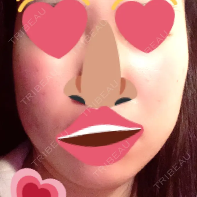 脂肪吸引（顔） フレッシュ整形外科 DAY 44 メイン用