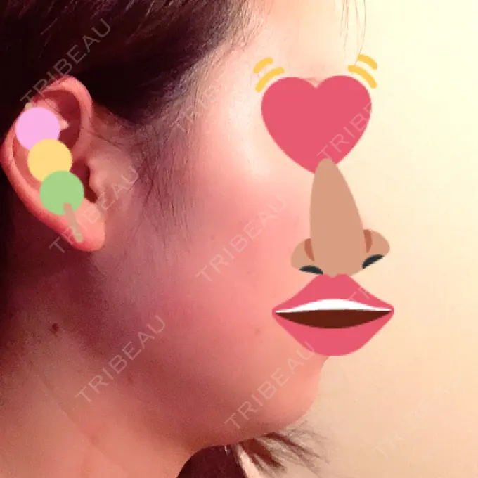 脂肪吸引（顔） フレッシュ整形外科 DAY 44 メイン用