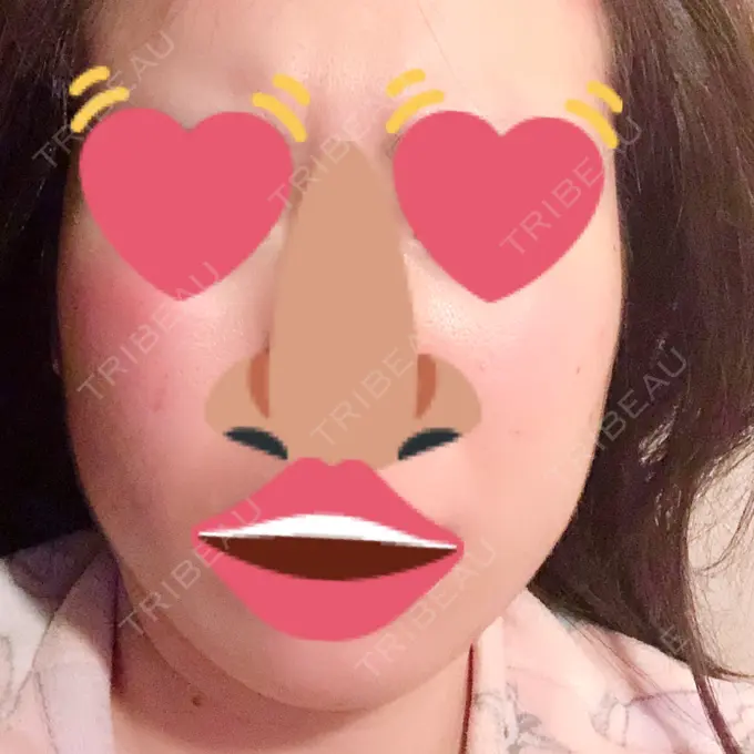 脂肪吸引（顔） フレッシュ整形外科 DAY 51 メイン用