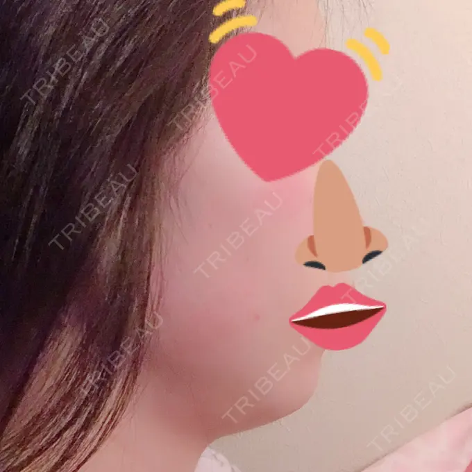 脂肪吸引（顔） フレッシュ整形外科 DAY 51 メイン用