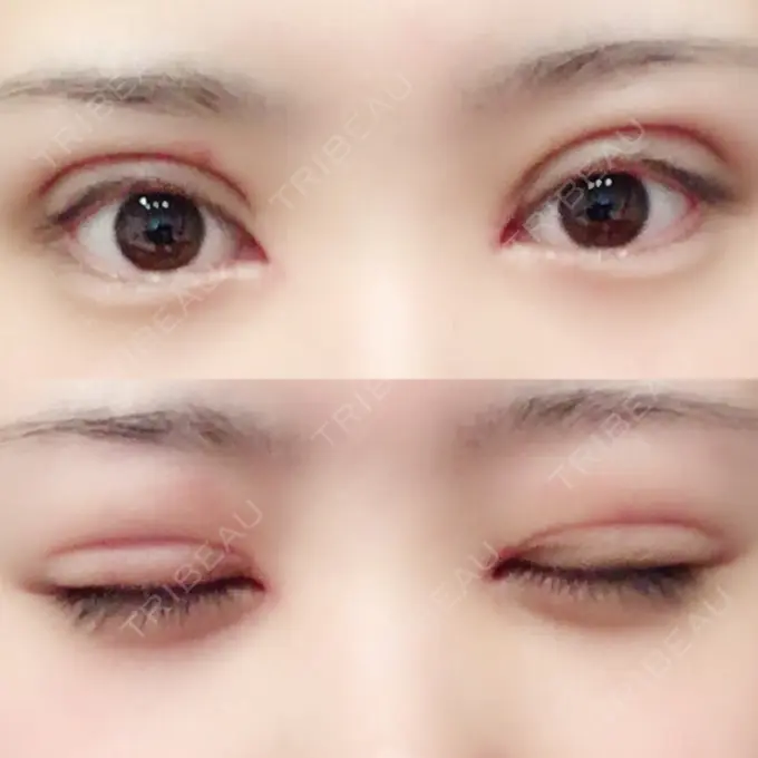 二重切開 / 目頭切開 城本クリニック 豊橋院 DAY 16 メイン用