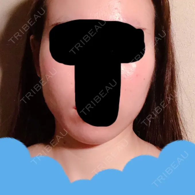 脂肪吸引（顔） フレッシュ整形外科 AFTER メイン用