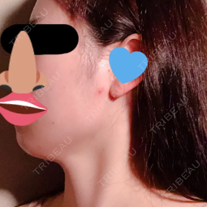 脂肪吸引（顔） フレッシュ整形外科 DAY 123 メイン用