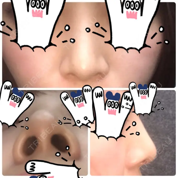 鼻尖形成（切開） / 軟骨移植 白山クリニック 大分 DAY 26 メイン用