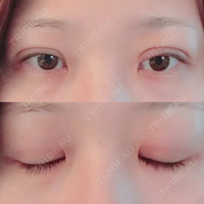 二重切開 城本クリニック 豊橋院 DAY 67 メイン用