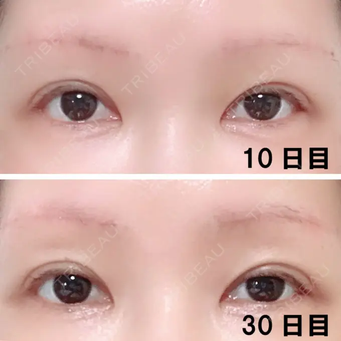 眉下切開 エイペックス美容外科 DAY 30 メイン用