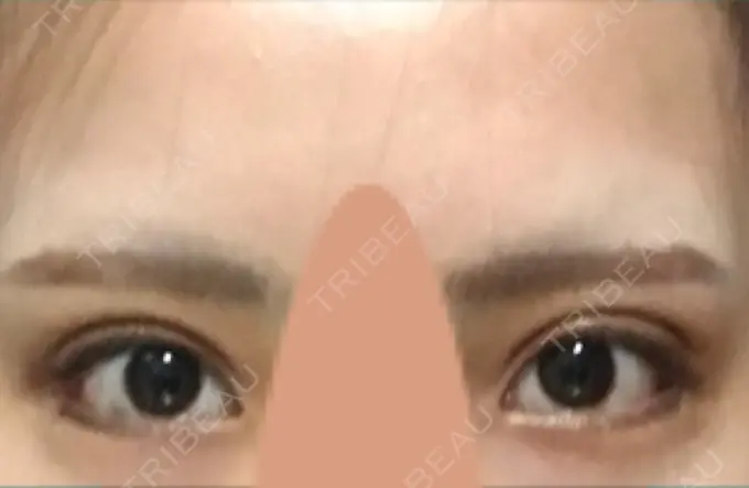 目尻切開 / 自然癒着法 FROM B整形外科 (旧バウム整形外科) DAY 16 メイン用