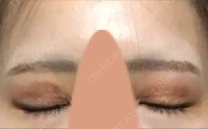 目尻切開 / 自然癒着法 FROM B整形外科 (旧バウム整形外科) DAY 16 メイン用