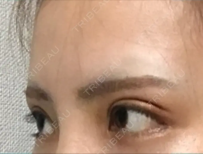 目尻切開 / 自然癒着法 FROM B整形外科 (旧バウム整形外科) DAY 16 メイン用