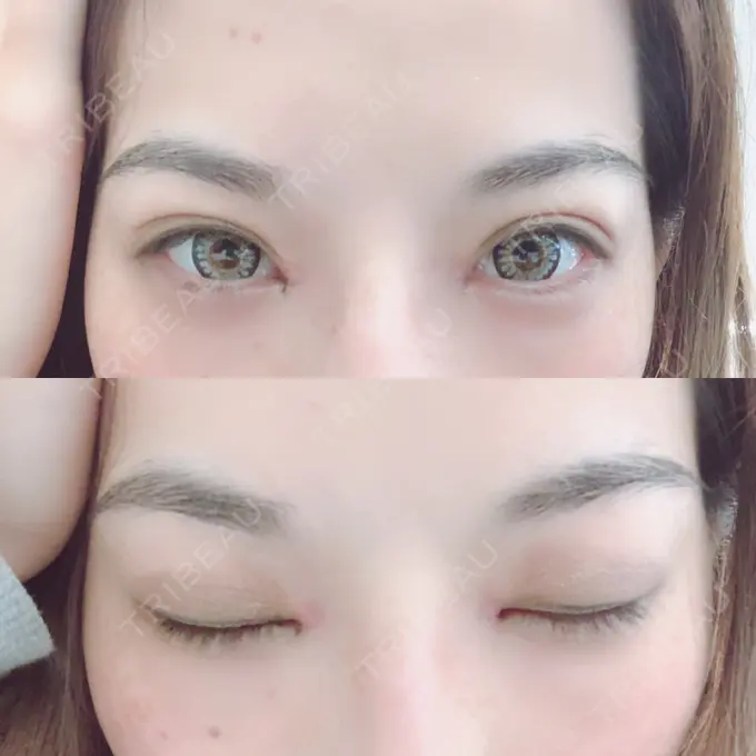 目頭切開 湘南美容クリニック 橋本院 AFTER メイン用