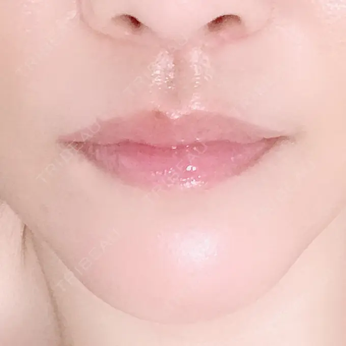 人中短縮 ドクターゴールドマンクリニック 大阪院 DAY 90 メイン用