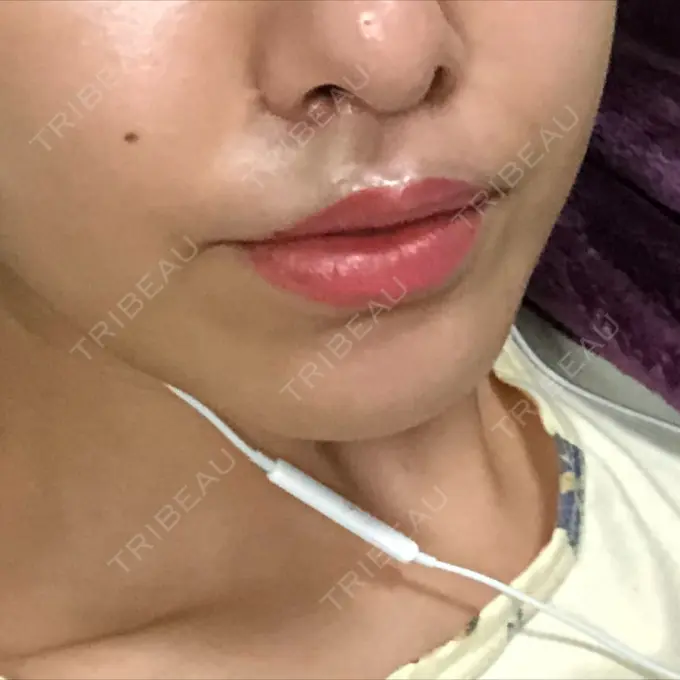 人中短縮 グリム整形外科 DAY 25 メイン用