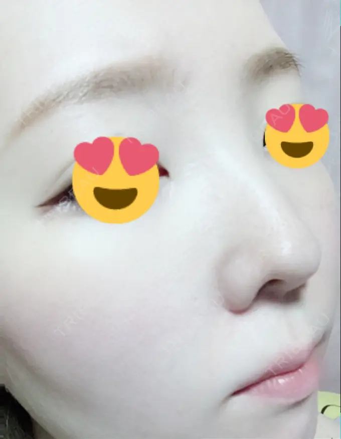 その他（肌） / 美肌レーザー みやた形成外科・皮ふクリニック DAY 14 メイン用