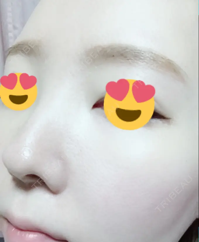 その他（肌） / 美肌レーザー みやた形成外科・皮ふクリニック DAY 14 メイン用