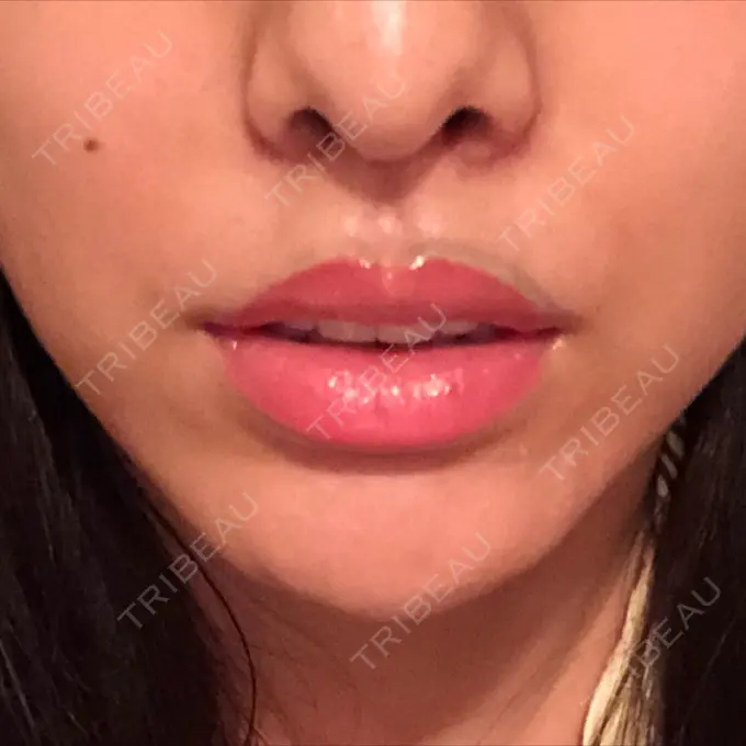 人中短縮 グリム整形外科 DAY 22 メイン用